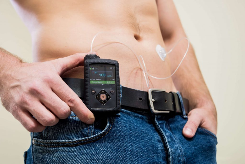 Insulin Pump What It Is And How Does It Work